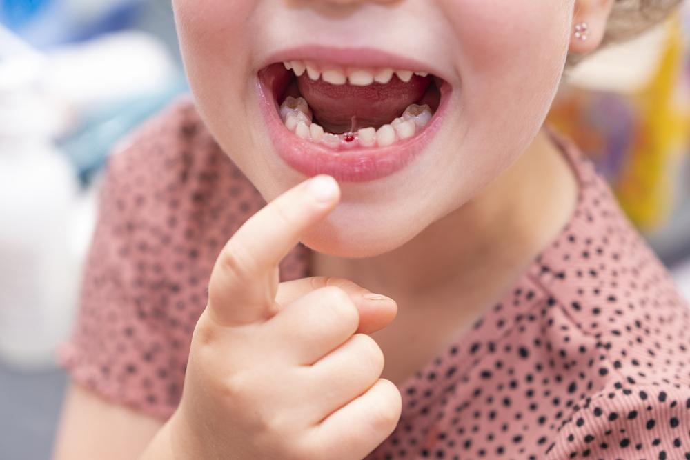 Tchau, dente de leite: quando acontece a troca de dentinhos