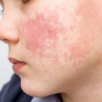 Foto de uma criança com alergia alimentar. Em destaque, está a bochecha do garoto com marcas bem vermelhas e irritação de pele..